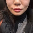 현대통통의원 | 강남역 피부과 입술필러 일주일 차 솔직 후기