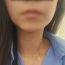컨티뉴페이스 | [일상]페이스 아쎄라 주사 후기 _ 붓기, 통증 1~2일차