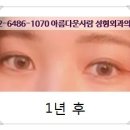 아름다운사람성형외과의원 네이버블로그