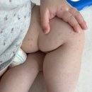16개월 아기 수족구 완치 후기｜고열, 입안 물집, 저체온 증상까지