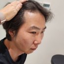 3400 | 부산 서면 모발이식 남성 M자 헤어라인 3400모 상담 후기