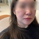 필업 | 신사역피부과 팔자주름 콜라겐주사 필업 효과 솔직 후기