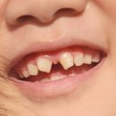 에이라인치과병원 | 청주에이라인치과 1차소아교정 일주일차후기