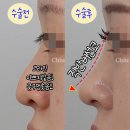 가미성형외과의원 | 직반버선코라인, 요즘 핫하던데 세련+고급짐+자연스러움 집합체