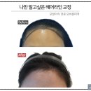 모발이식잘하는곳 나만 알고싶은 헤어라인교정 실제 후기(4개월 경과)