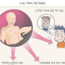 수두 초기 감염경로 진단 예방 이미지