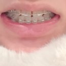 이편한세상치과의원(화곡점) | [교정일기 25개월 차] 아 이제 교정 좀 지겨운데 언제 끝나냐 *내돈내산