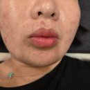 정메디칼 | 청라여드름 청라피부관리 솔에스테틱 인천청라점 여드름관리 솔직후기