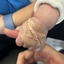 마포 에스엔유 피부과 이소성 몽고반점 레이져 1차, 2차 후기