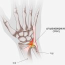 유진정형외과의원 | 죽어가는 손목 살리기 | 은평성모병원, 광주상무병원, 유상호 정형외과