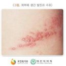 통증 대상포진 원인 초기 증상 전염성 병원 치료 이미지