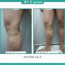 하지정맥류수술분석후기] 체격이 좋은 남성에게서 나타난 다리 혈관! 하지정맥류가 맞나? 이미지