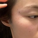 안심한의원 | 강남역 한의원 편평사마귀 점 제거 비립종 제거 레이저 후기