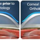 줌안경콘택트 이미지