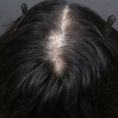 careful hair | 영등포역 탈모치료, 전문병원 찾다가 정착한 솔직 후기