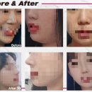 피에스성형외과의원 | 코수술잘하는곳 강남역12번출구 더도어성형외과