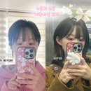 엘프뷰티 | 내돈내산 누운귀 성형 수술 1달 후기 엘프귀 붓기, 아픔, 흉터, ( 필러X 아님)