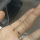 이기웅정형외과의원 | 손가락 베였을때 베임상처 서울기운찬정형외과
