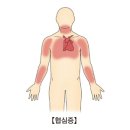 협심증(Angina pectoris) 이미지