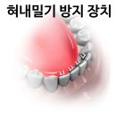 센트럴치과의원 | 앞니 치아 벌어짐, 과개교합 비발치 교정 센트럴 전문 치과 후기