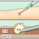 진피에 넣는 주사가 그렇게 아프다며? 얼굴 전체에 포뜨듯이 넣는 주사, 리쥬란 이미지