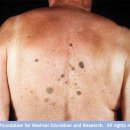 Melanoma 이미지