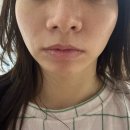 튠스타트 | 강남역 피부과 탄력 관리, 강남 튠페이스 + 튠라이너 솔직 후기 (통증, 효과, 주의사항)