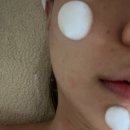 비채움뷰티 | 연신내 피부관리 안은경뷰티어겐에서 트러블 잡았어요