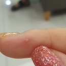 박앤리피부과의원 | 상인역 박앤리 피부과 - 손가락 티눈 치료 후기