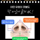 오뚝 | 여자 코수술 코끝 연골묶기 비용·가격·회복기간·전후 효과 후기