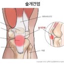 슬개건염, 슬개골 연골 연화증 (무릎 통증 염증) 이미지