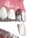 하이치과기공소 이미지