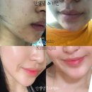 인셀덤꿈틀 | [포항 인셀덤] 트레블키트 내돈내산 후기♥