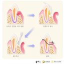 만성 복합치주염으로 치아 임플란트 8개를 한 경우 질병 후유장해를 받을 수 있습니까? 이미지