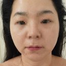 평택 고덕에스테틱 드피엘피부연구소에서 받은 리프팅관리 찐후기 !