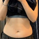 멍택시 | 천호 복부무한람스 2주차 현실 후기 / 당일부터~멍 흉터 통증 과정 +짝짝이 붓기 경과 후관리