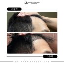청담서울여성외과의원 | 청담 모발이식, 잘 알아보고 선택하자