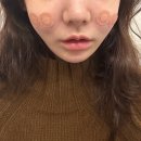 토마스동물병원 | 유라인클리닉 윤곽주사 광대컷주사 솔직 후기