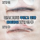 소사역남부 | 소사역 아이라인제거 반영구문신제거 미오름뷰티