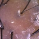 밥하는남자 | 수원 지루성두피관리 탈모관리 두피밥 재방문 후기