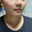 휴니즈 | [송도성형외과] 팔자주름필러/통증/주의할점/효과