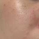 좋은빌딩((유)좋은사람들) | 유앤아이의원 홍대신촌점 잡티제거 내돈내산 후기