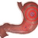 서강약손한의원.강내과의원 | 부산내과 강내과의원 서강약손한의원에서 위궤양 치료하세요~
