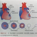신계한의원 | 급성관상동맥증후군, 심내막하경색등 5분 심장질환정리