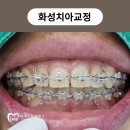 화성치아교정 삐뚤어진 앞니만 치료 가능할까요?