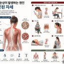 근막(Fascia)이란 무엇인가?｜근막의 역할과 손상 시 나타나는 통증·체형 문제 총정리 이미지