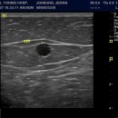 Great saphenous Vein Reflux (varicose vein) 이미지