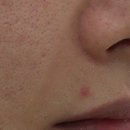 노블캣 | 노블캣 수술 후 부작용 후기 (1탄)