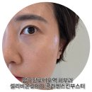 압구정로데오역 피부과 셀리비온린제이 후기, ECM 콜라겐 스킨부스터 효과