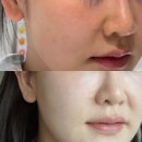 피시오나도 | 강남색소치료 코어레이저 받고 왔슴다, 맑아졌다구!!!